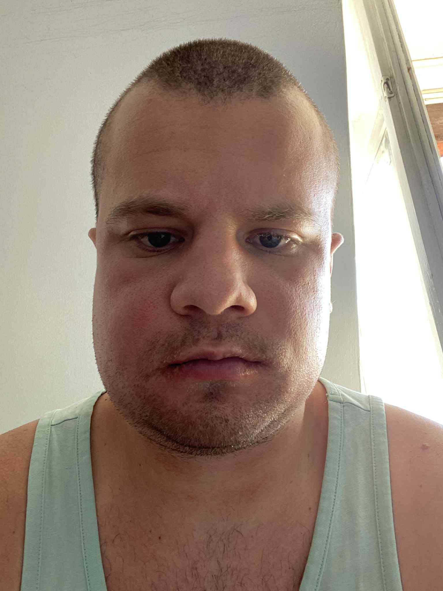 Zdjęcie po operacji szczęki
